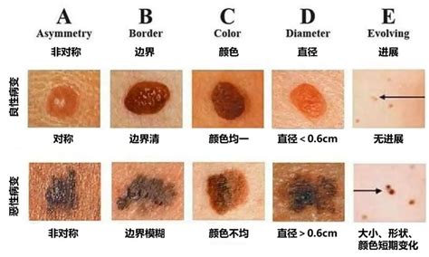 一颗痣